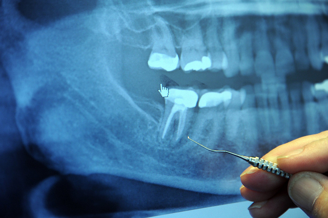 what to expect during your dental appointment to our Prescott office - large x-ray of teeth