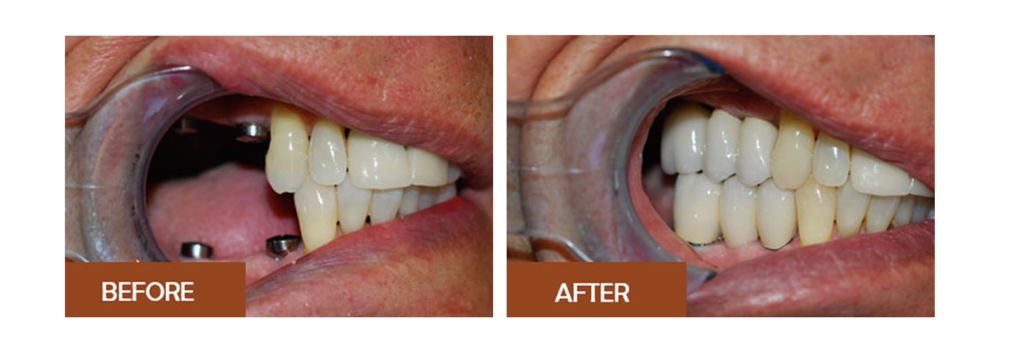 Before and After images of teeth