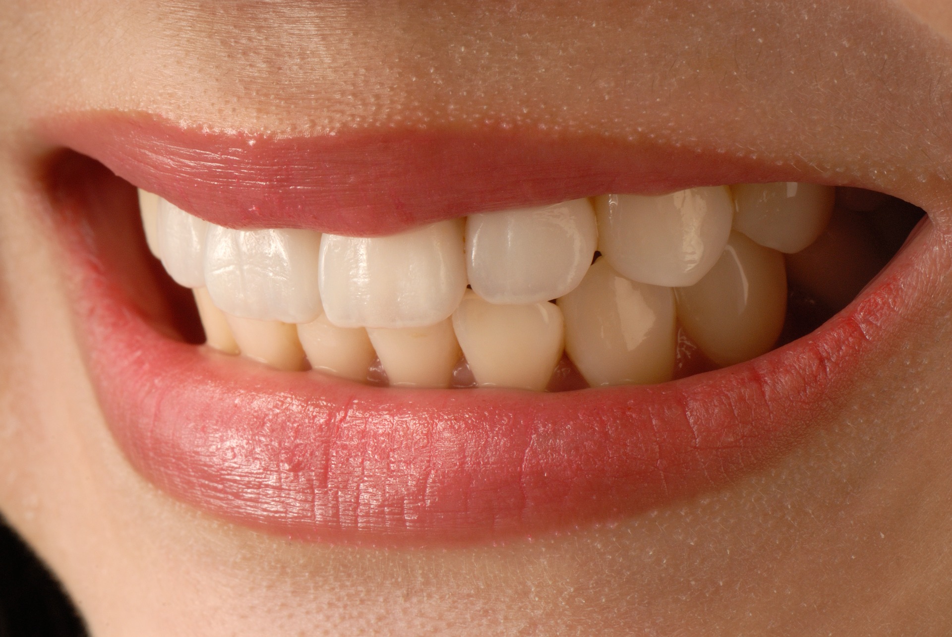 How Long Do Veneers Last Hicks Dental Group