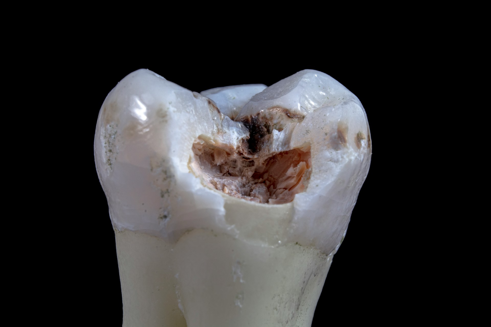 tooth with a cavity - how to treat a cavity