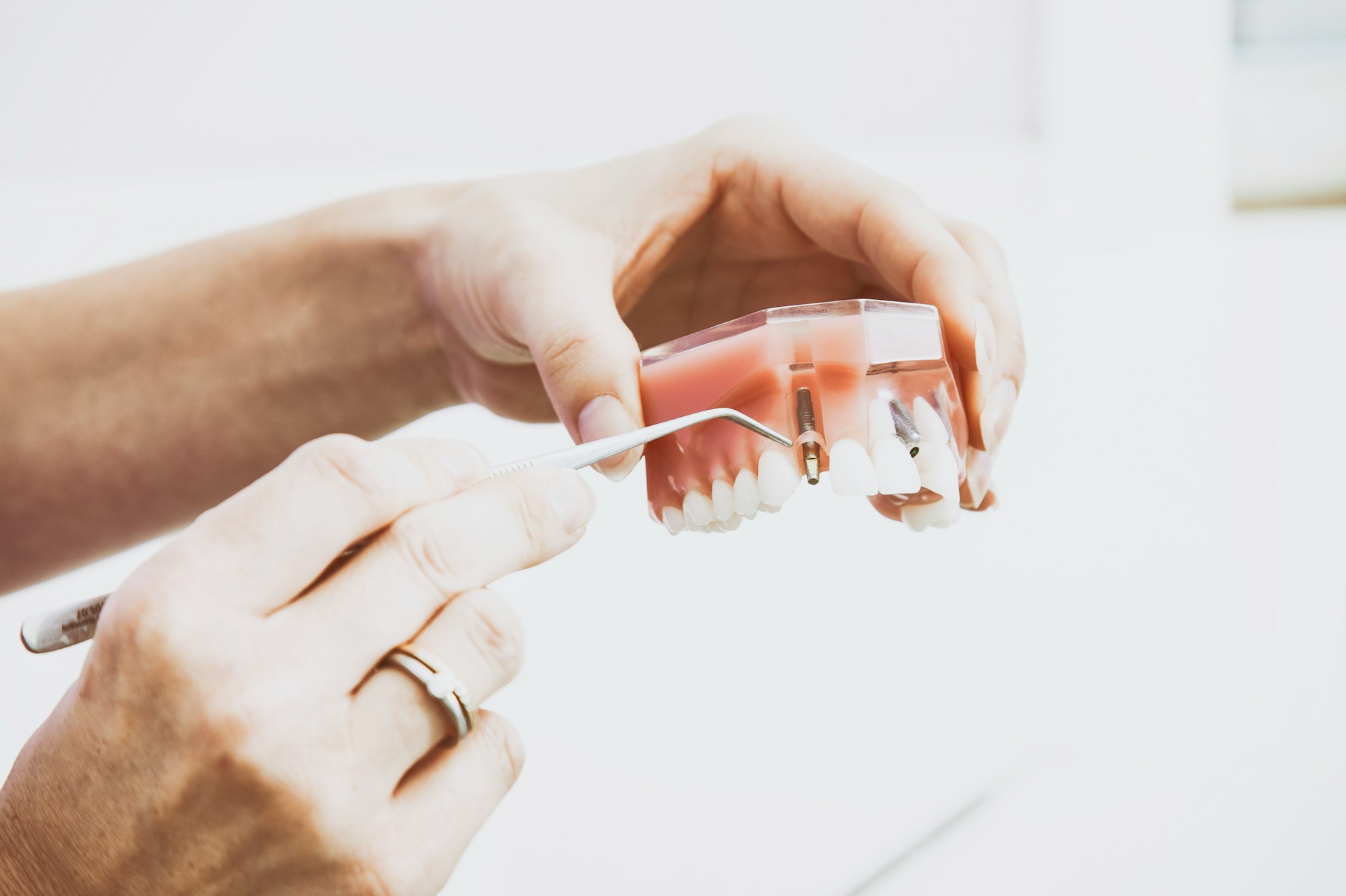 model showing dental implant - dental implants preserve jawbone